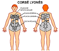 La escoliosis el dolor da en el pie